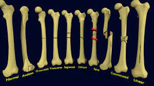 HBOT Therapy Bone Fracture in Aurangabad